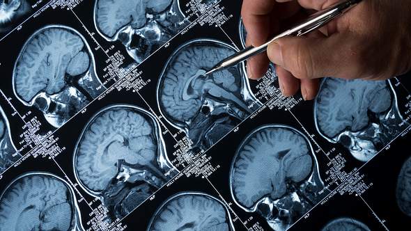 Gehirn-Scan im Detail - Foto: Istock/haydenbird
