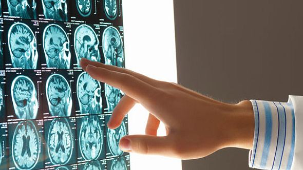 Gamma Knife Strahlen können Gehirnareale erreichen, an die man nicht mehr mit einem Skalpell herankommt