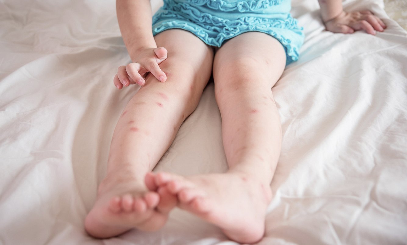 Mückenstiche behandeln beim Kind