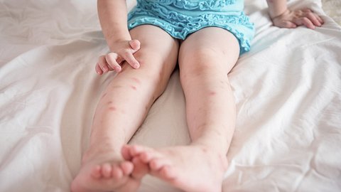 Mückenstiche behandeln beim Kind - Foto: istock/parinyabinsuk