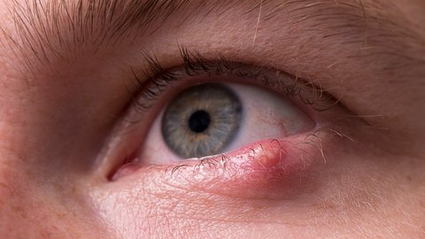 Nahaufnahme eines Mückenstichs am Auge - Foto: iStock_RuslanDashinsky