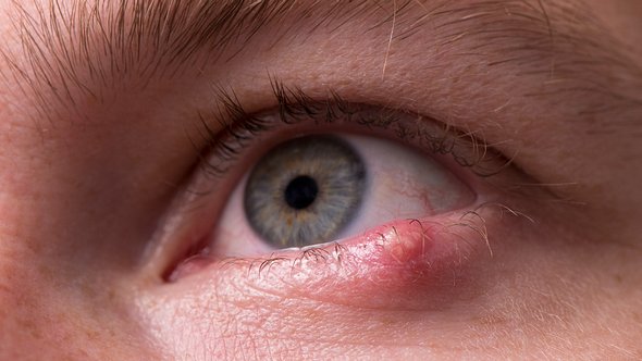 Nahaufnahme eines Mückenstichs am Auge - Foto: iStock_RuslanDashinsky