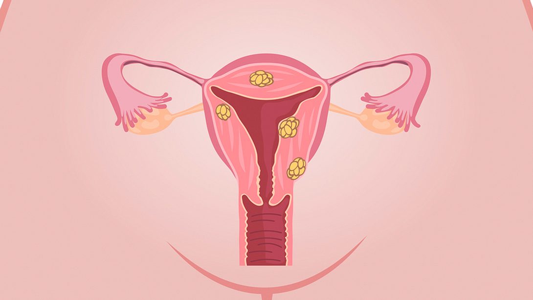Myom in der Gebärmutter - Foto: istock/FancyTapis