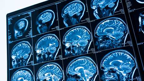 Mysteriöse neue Krankheit greift Nervensystem an: Forscher vor Rätsel - Foto: iStock / Movus
