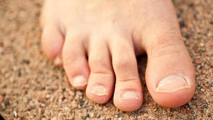 Bei einer Nagelpilzinfektion an den Fußnägeln sind der große und der kleine Zeh am häufigsten betroffen - Foto: IStock