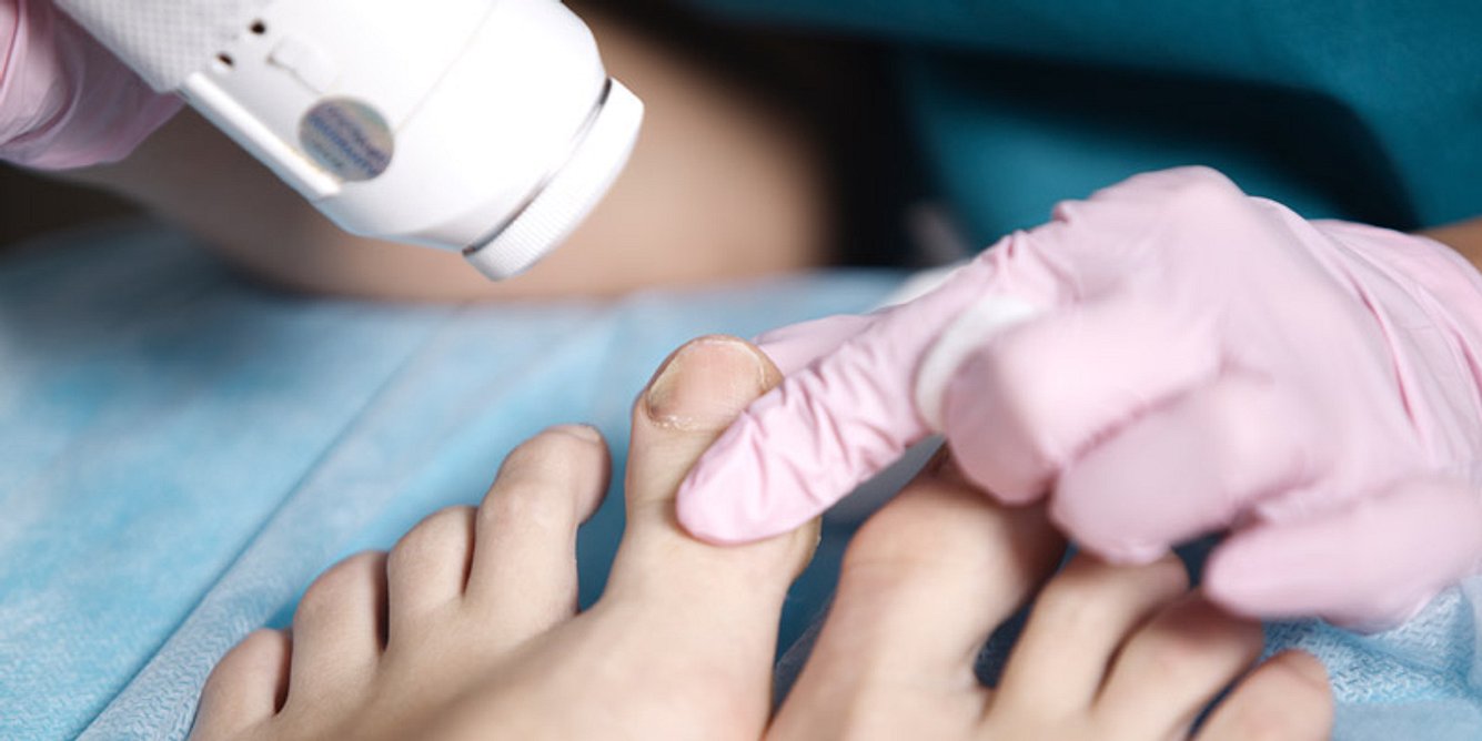 Laser zur Nagelpilz-Behandlung
