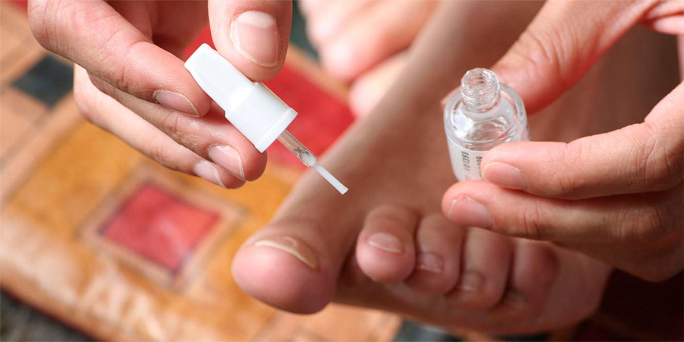 Nagelpilz kann mit farblosen Lacken behandelt werden