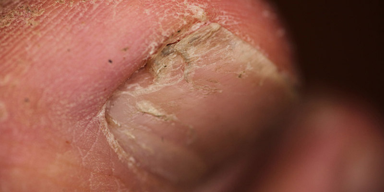Beginn einer Nagelpilz-Infektion | Nagelpilz-Bilder: So erkennen Sie das nervige Leiden | PraxisVITA