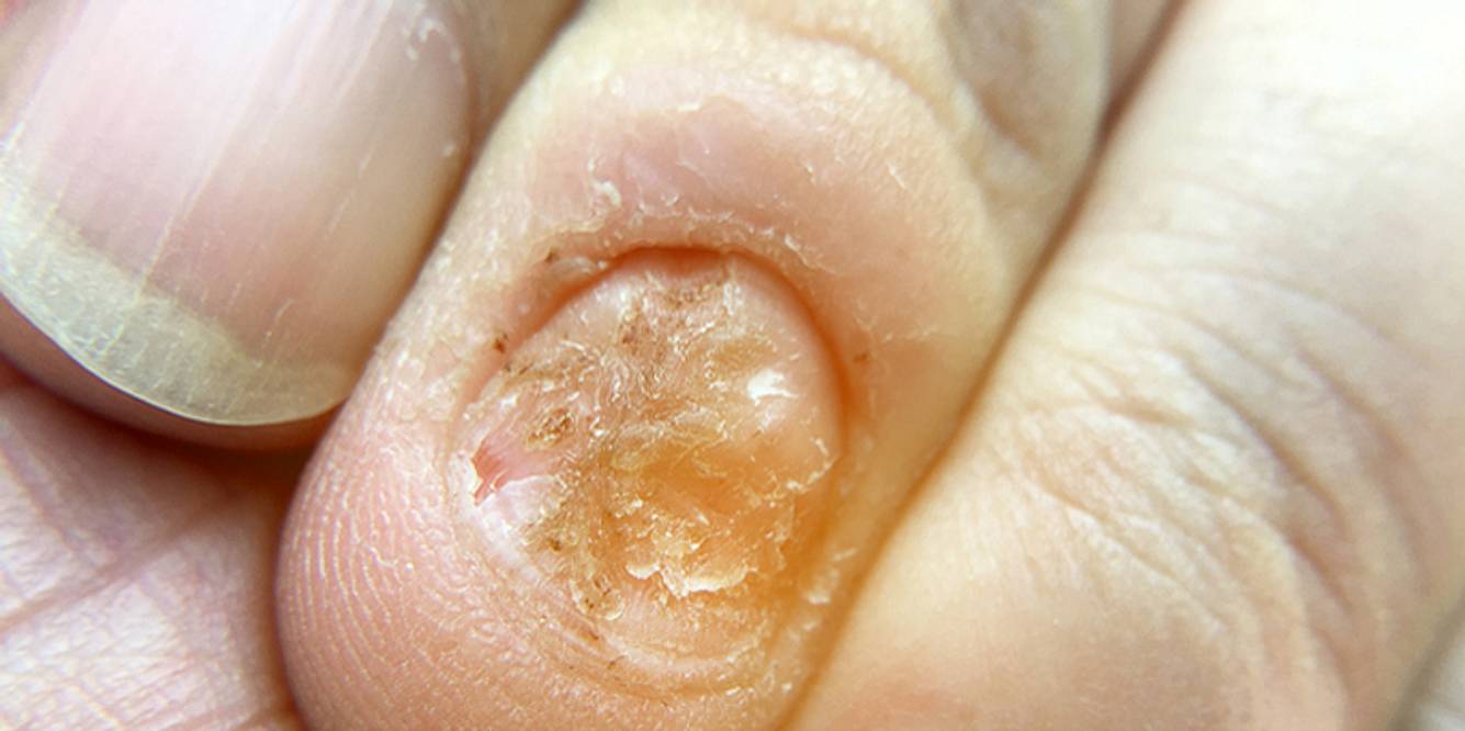 Nagelpsoriasis
