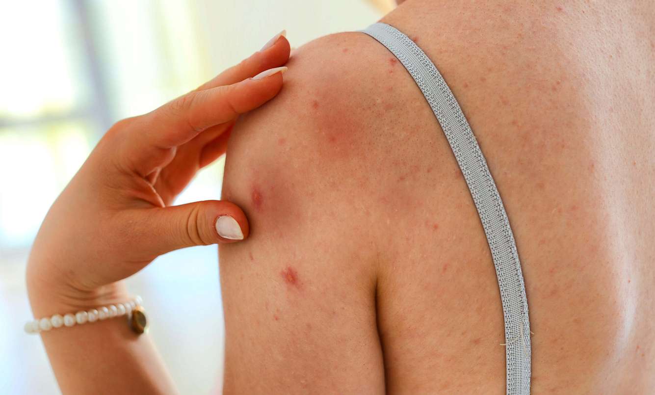 Frau mit rotem Ausschlag auf der Schulter