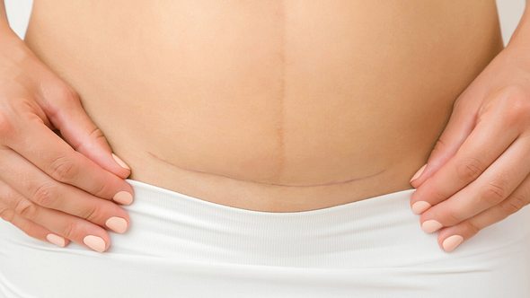 Nackter Frauenbauch mit Kaiserschnittnarbe in Großaufnahme - Foto: iStock-1176500076 FotoDuets
