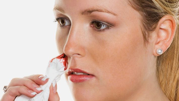 Worin besteht bei Nasenbluten die Therapie?