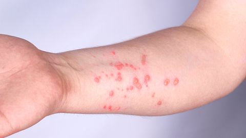 Arm mit Pusteln - Foto: iStock/Anna Shalamova