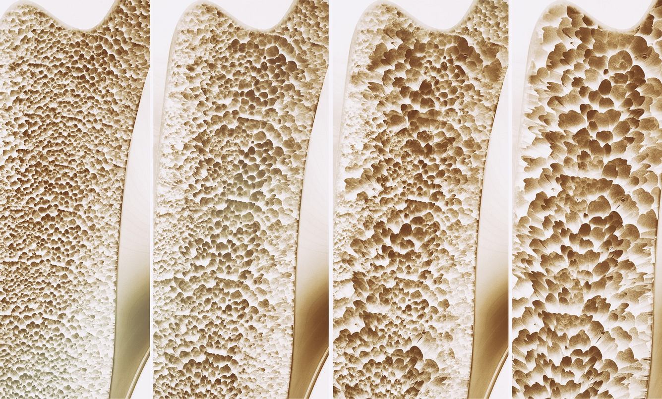 Bei Osteoporose nimmt die Knochendichte ab.