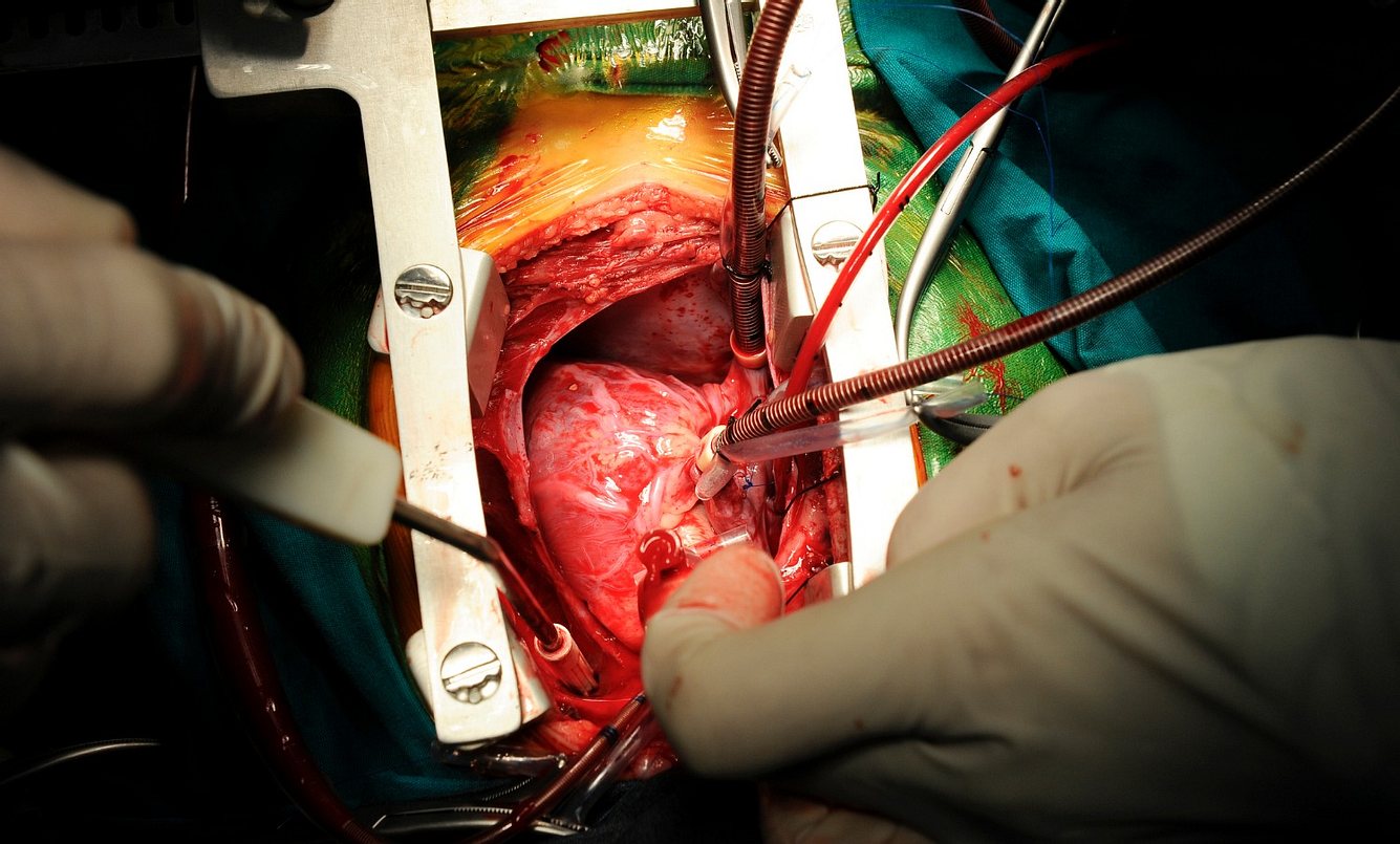 Herztransplantation: Bald schlägt das erste Schweineherz im Menschen