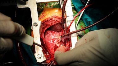Herztransplantation: Bald schlägt das erste Schweineherz im Menschen - Foto: baranozdemir/iStock