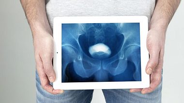 Zur Diagnose eines Penisbruchs macht der Arzt eine Röntgenaufnahme der Penisschwellkörper (Cavernosografie)