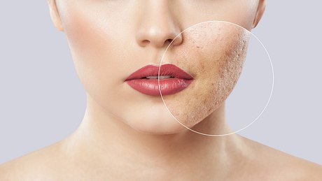 Ein Frau mit einseitiger Akne im Gesicht - Foto: istock_dimid_86