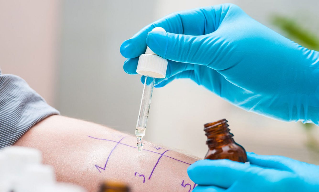 Arzt macht Pricktest, um auf Schimmelpilzallergie zu testen