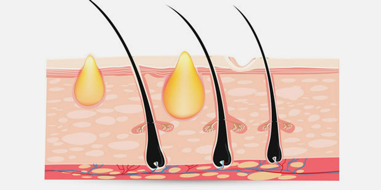 In der Pubertät erhöht sich die Talg-Produktion, zugleich werden vermehrt Hornzellen an der Hautoberfläche gebildet. Die talgtransportierenden Drüsengänge verschließen sich, es entstehen Mitesser, die durch Bakterien zu Eiter-Pickeln anwachsen können