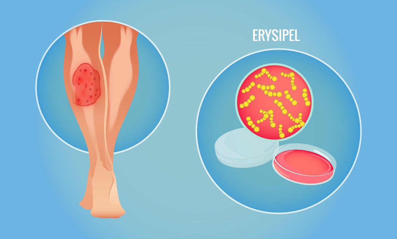 Erysipel