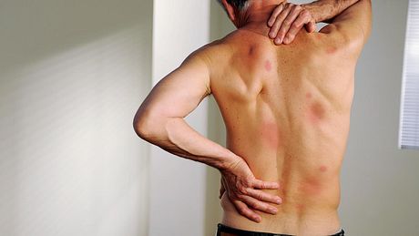 Rote Flecken am Körper - Foto: iStock/peepo