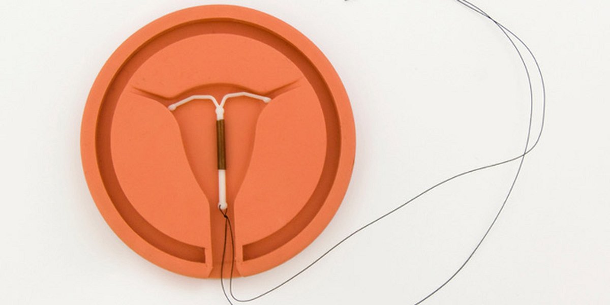 Die Spirale danach wird vom Frauenarzt in die Gebärmutter der Patientin eingesetzt