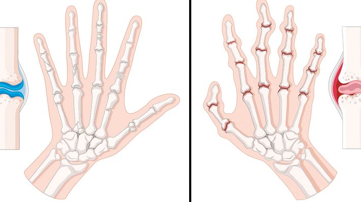Grafik zeigt, wie sich Rheuma in den Händen auswirkt - Foto: istock/colematt
