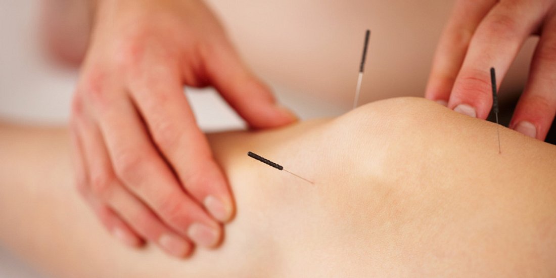 Arthrose im Knie: Akupunktur