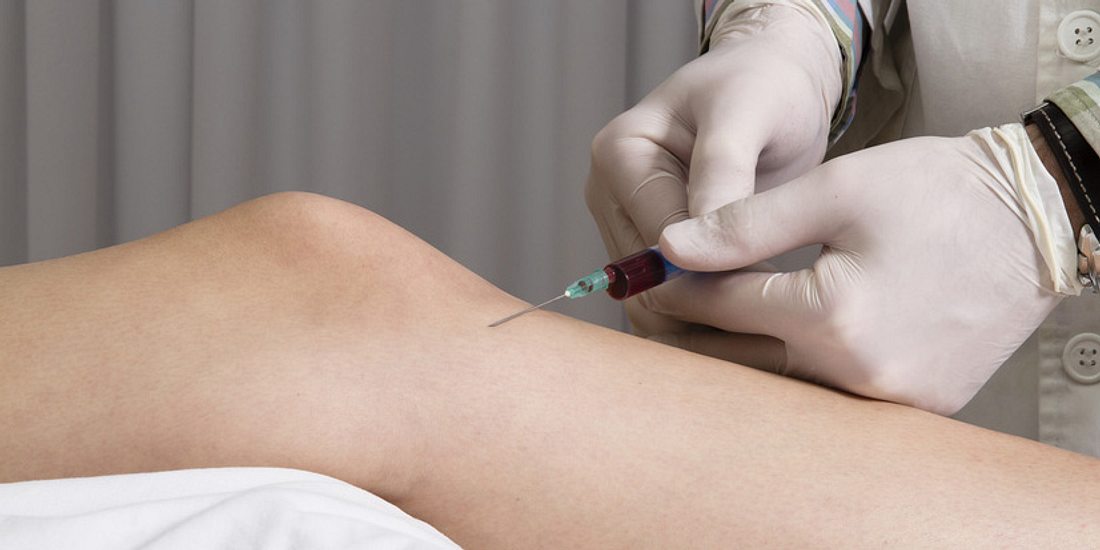 Arthrose im Knie: Kortison-Injektionen