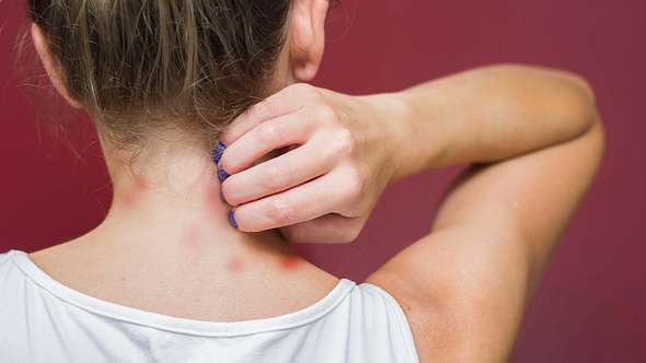 Frau hat rote Flecken am Hals - Foto: iStock/Thiago-Santos