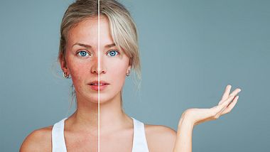 Rote Flecken im Gesicht können unterschiedliche Ursachen haben. - Foto: iStock/Wpadington