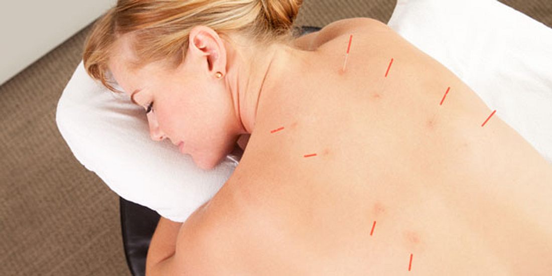 Akupunktur gegen Rückenschmerzen