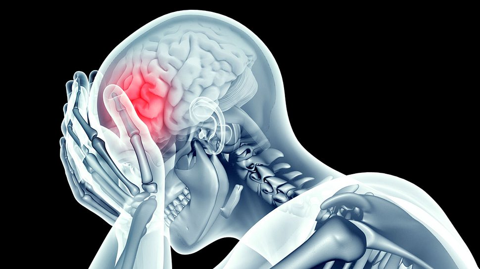 Röntgenbild Schädel-Hirn-Trauma - Foto: iStock/posteriori