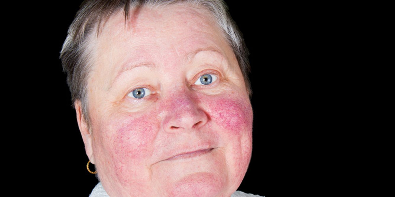 Bei Lupus weisen fast die Hälfte aller Betroffenen das sogennate Schmetterlingserythem, die Schmetterlings-Röte im Gesicht auf