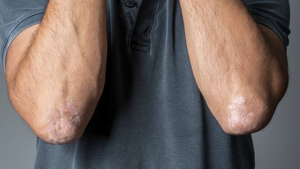 Schuppige Haut an den Ellenbogen eines Mannes - Foto: iStock_ozgurdonmaz