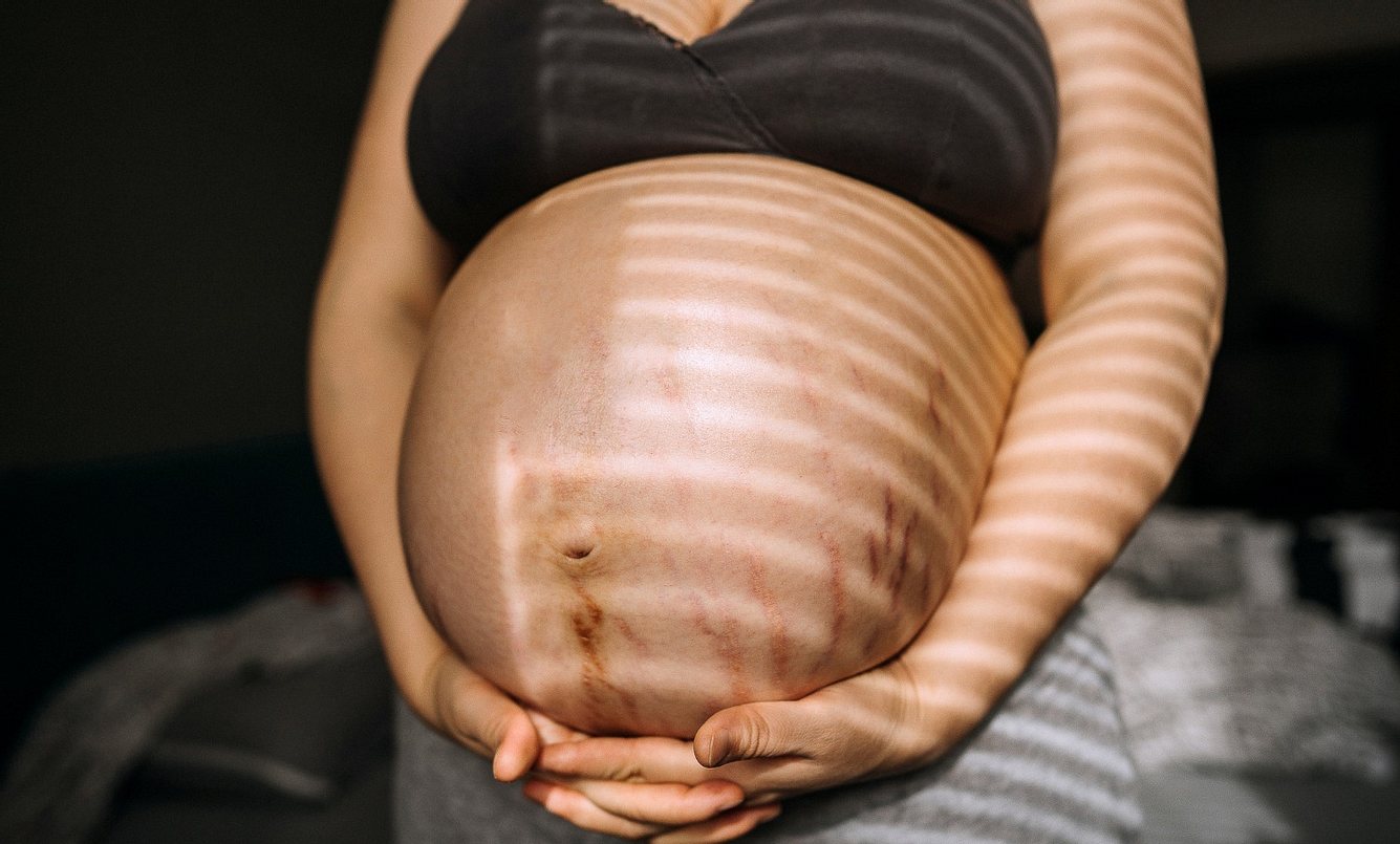 Eine schwangere Frau mit rundem Bauch, auf dem viele Dehnungsstreifen sind