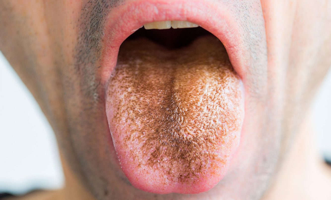 Bei der sogenannten schwarzen Haarzunge verfärbt sich die Zunge bräunlich oder schwarz