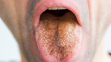 Bei der sogenannten schwarzen Haarzunge verfärbt sich die Zunge bräunlich oder schwarz - Foto: VOISIN/PHANIE/iStock