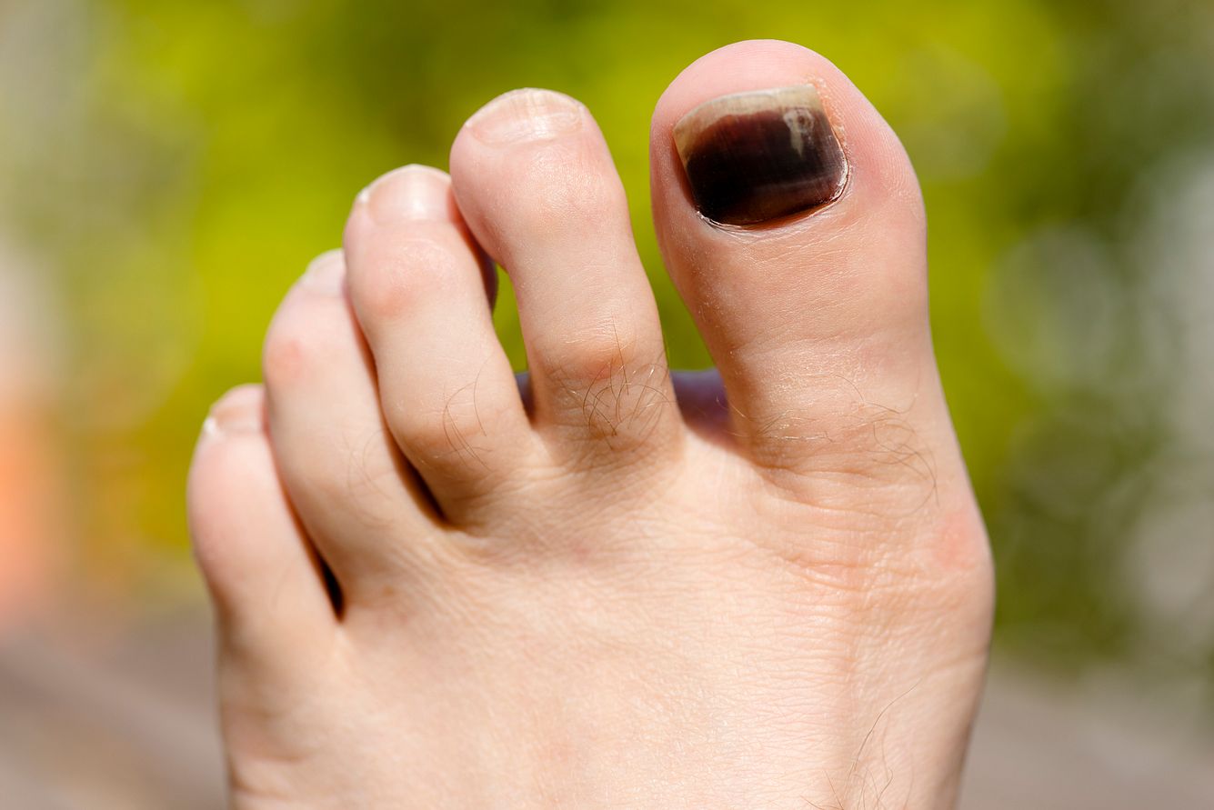 Ein Fuß mit einem schwarzen Zehennagel des großen Zehs