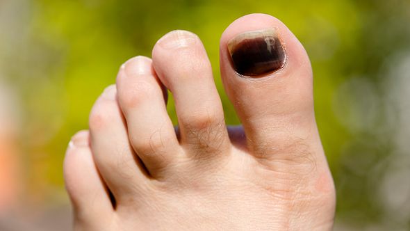 Ein Fuß mit einem schwarzen Zehennagel des großen Zehs - Foto:  iStock / Christopher Ames