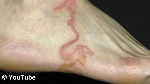 Screenshot eines YouTube-Videos über einen Parasiten im Fuß eines Patienten - Foto: YouTube