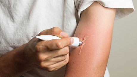 Creme auf Sonnenbrand am Arm schmieren - Foto: iStock/Photoboyko