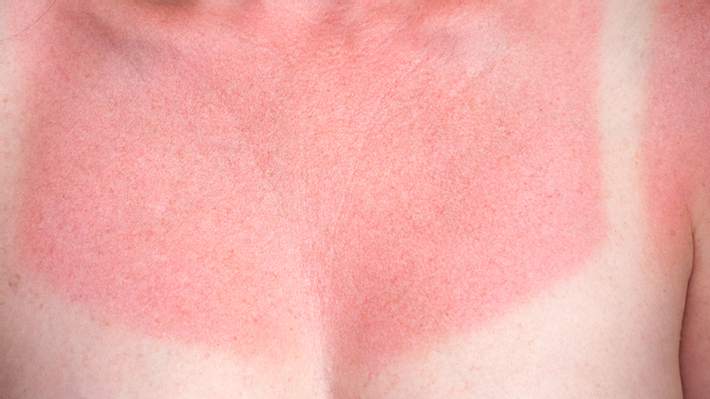 Sonnenbrand - verhindern und wirkungsvoll behandeln