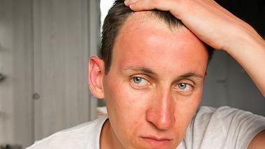 Gesicht mit Sonnenbrand - Foto: iStock/LENblR