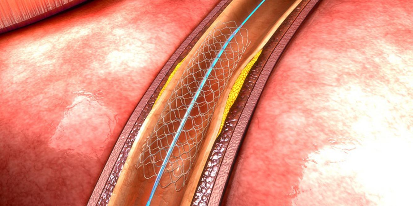 Stent löst Blutgerinnsel im Kopf auf