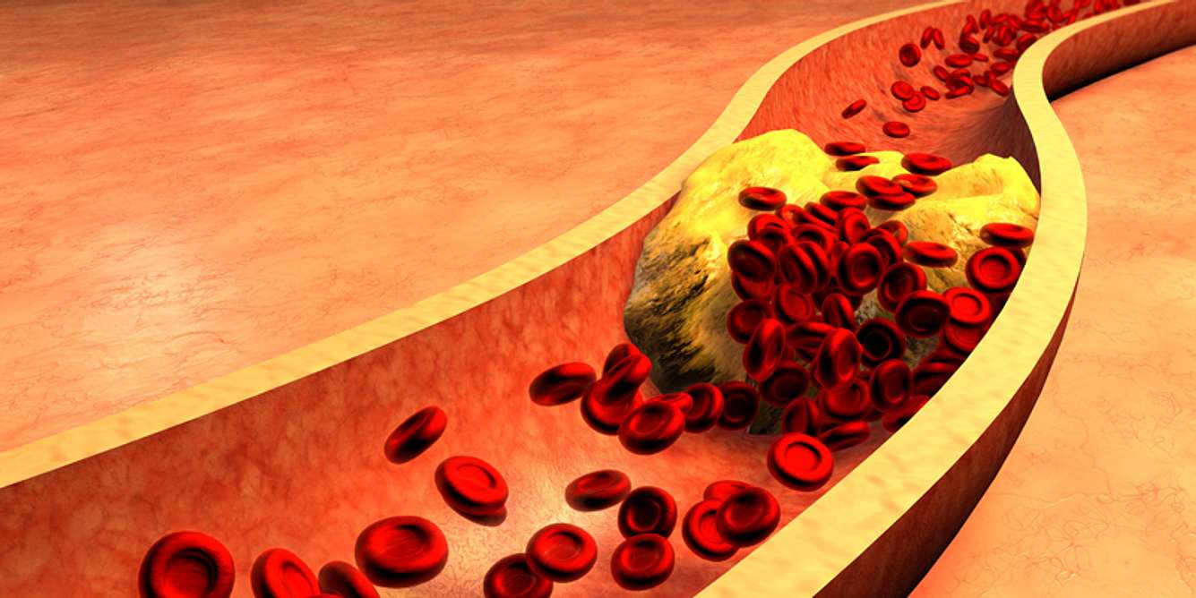 Thrombose-Anzeichen