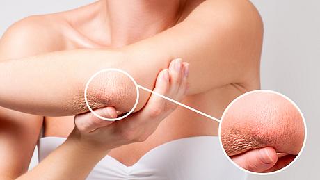 Trockene Ellenbogen - Foto: istock/flisak