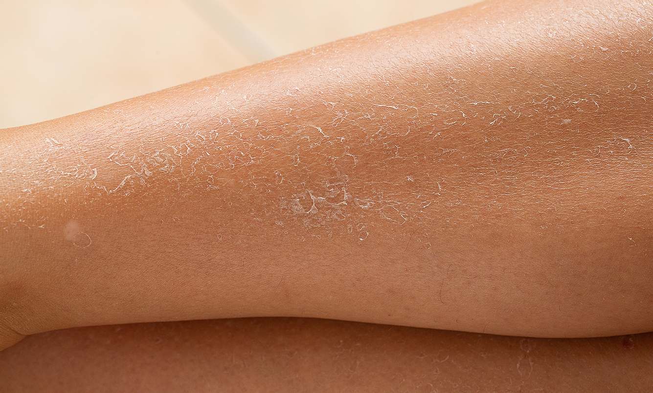 Trockene schuppige Haut an den Beinen: Was kann ich tun?