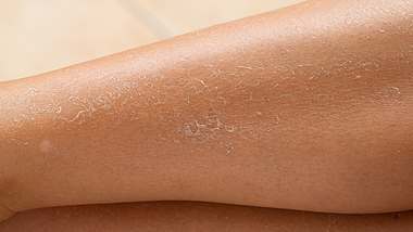 Trockene schuppige Haut an den Beinen: Was kann ich tun? - Foto: iStock / sruilk